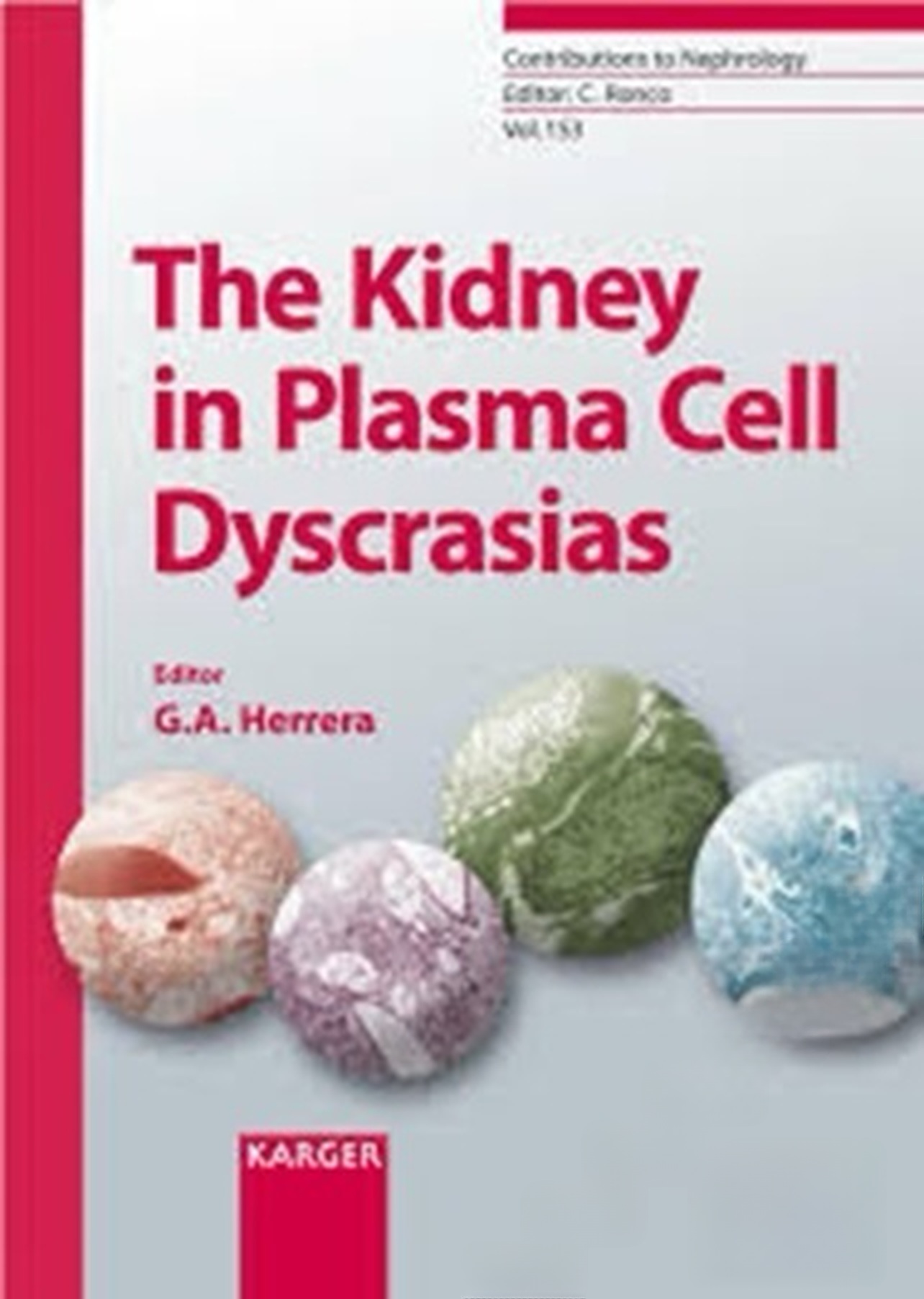 The Kidney in Plasma Cell Dyscrasias